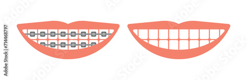 Human mouth with and without braces beautiful smile vector illustration.