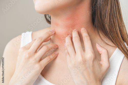 Dermatology concept, asian young woman, girl allergy, allergic reaction from atopic, insect bites on her neck, hand in scratching itchy, itch red spot or rash of skin. Health care, treatment of beauty photo