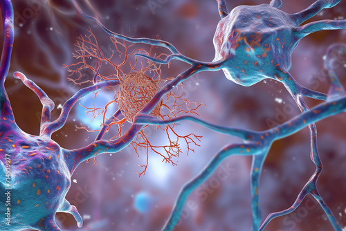 3d rendered illustration of neuron, dementia photo