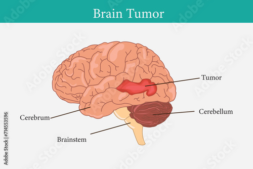 Brain problem. Malignant cells develop in the human brain. Human brain structure anatomy. eps 10