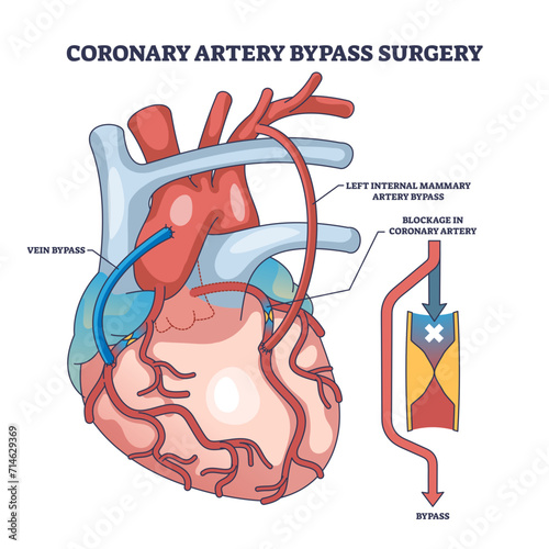 Coronary artery bypass surgery for blocked blood flow outline diagram, transparent background. Labeled educational scheme with heart procedure and cardiology condition illustration. photo