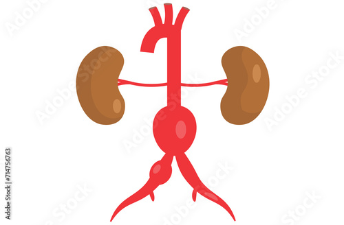 abdominal aortic aneurysm,heart aorta attack, aortic arch bulge open,vein clots stent stroke Marfan root left graft, hernia vessel pain High blood kidney damage Turner,red,pink,purple