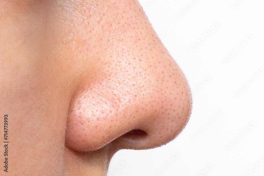 © Janeberry - Close-up of a young woman's face with sweat and oily shine on her nose. Large enlarged pores and blackheads on the skin of the face. Comedones, acne, hyperhidrosis. Facial skin problems