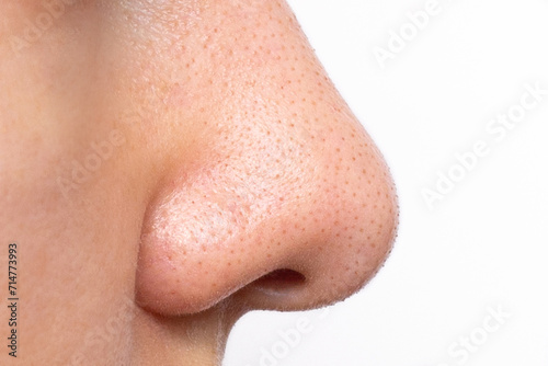 Close-up of a young woman's face with sweat and oily shine on her nose. Large enlarged pores and blackheads on the skin of the face. Comedones, acne, hyperhidrosis. Facial skin problems photo