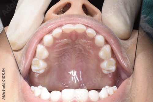 Upper maxillary arch occlusal indirect mirror view of a eight year old child dentition. Healthy gingival gum, palate, teeth aligned and no decay. Directly below view medical photography. 