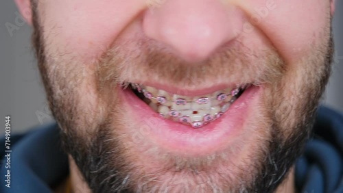 Adult Caucasian Male with Serious Malocclusion of Chipped and Damaged Teeth with Metal Dental Braces For Orthodontic Treatment photo