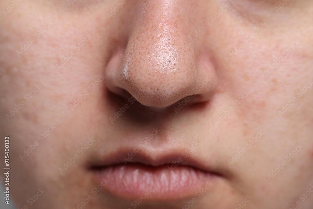 Closeup view of woman with comedones on her nose Closeup view of woman with comedones on her nose