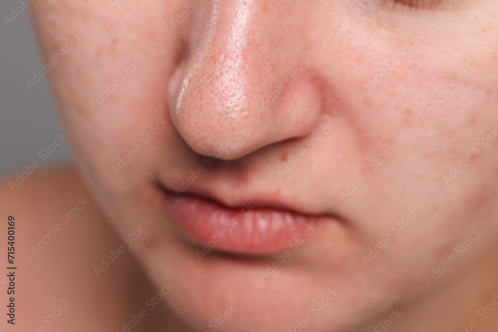 Fototapeta premium Closeup view of woman with comedones on her nose