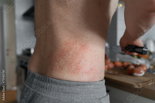 Close-up of man's body belly at home in kitchen with dermatitis rush and red irritation on the skin. photo