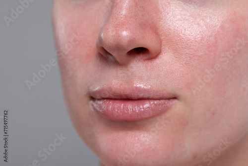 Closeup view of woman with reddened skin on grey background