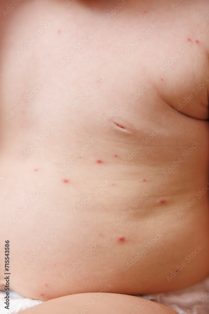 Detail of baby's skin covered with chickenpox blisters Detail of baby's skin covered with chickenpox blisters
