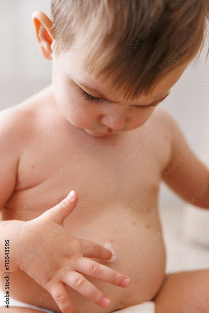 Toddler boy spreading ointment on Varicella or chickenpox blisters Toddler boy spreading ointment on Varicella or chickenpox blisters