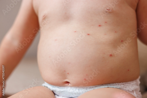 Detail of baby's skin covered with smallpox blisters