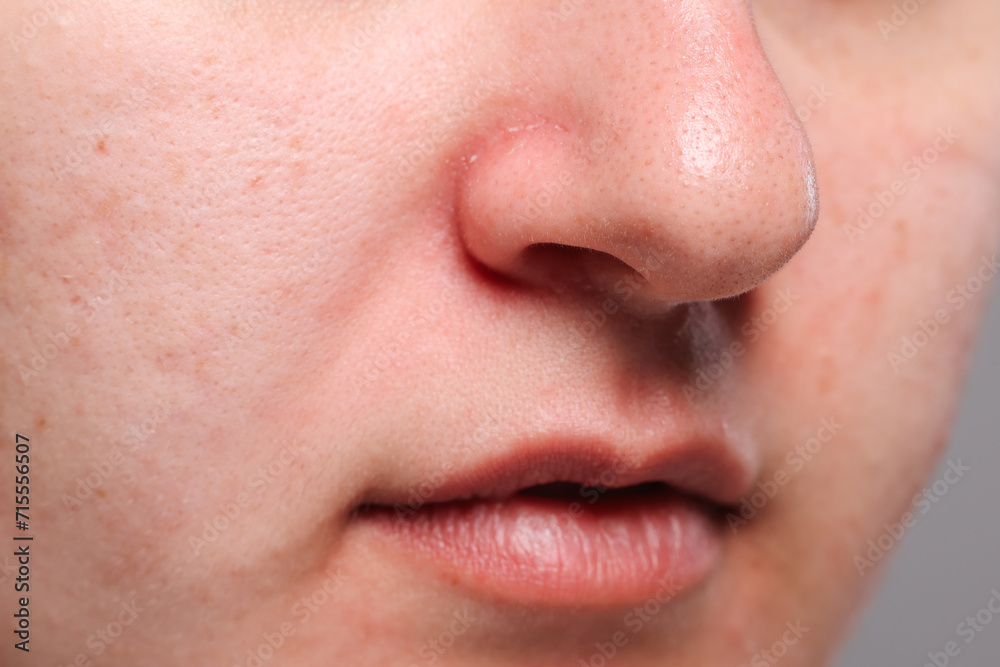 Closeup view of woman with comedones on her nose Closeup view of woman with comedones on her nose