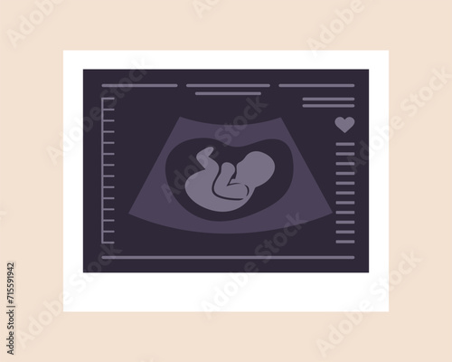 Ultrasound of baby. Embryo in womb. Pregnancy screening. Baby health diagnostic. Fetus silhouette photo. Sonography or ultrasonography concept. Vector illustration in flat cartoon style.