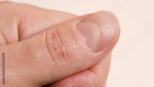 Ridged fingernail of a thumb finger of a man with horizontal ridges on white background