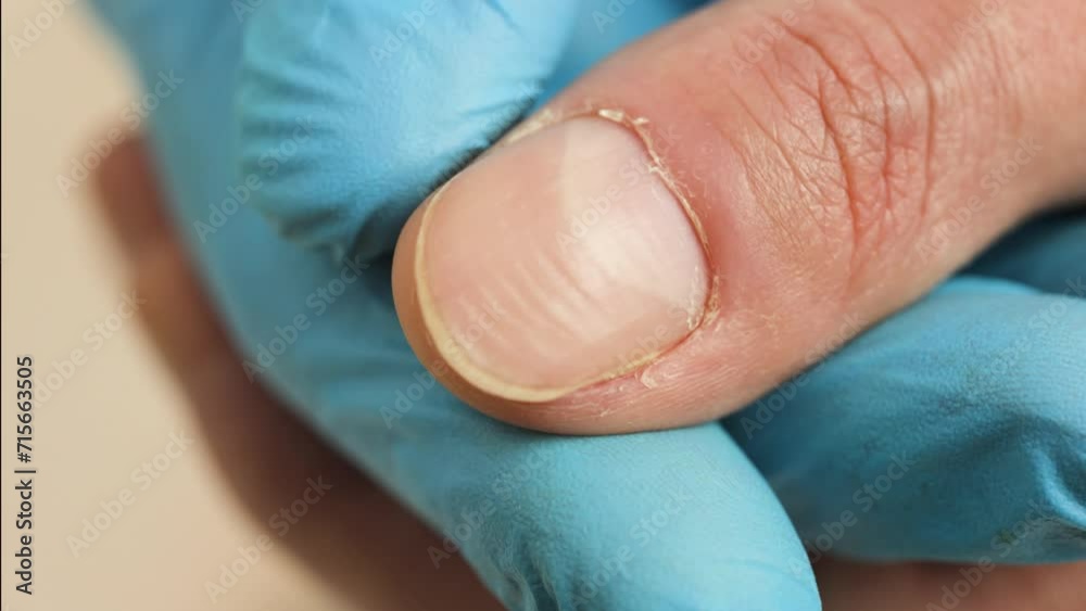 Vid o stock doctor examining a ridged fingernails with vertical and