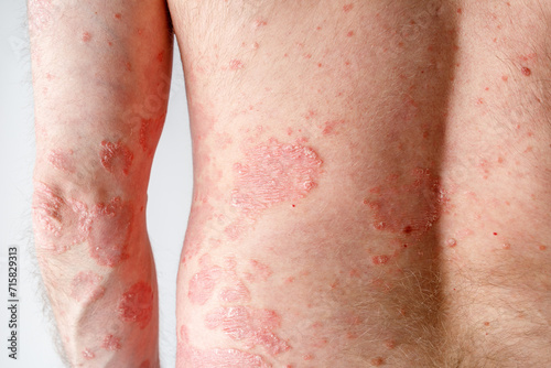 Papules of chronic psoriasis vulgaris on male arm and back body on neutral background. Genetic immune disease. photo