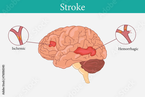 Stroke disease, ischemic, and hemorrhagic. Scientific medical illustration of human brain stroke illustration. illustration, vector.