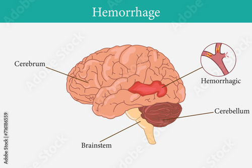 Human anatomy disease hemorrhagic stroke vector illustration on white background