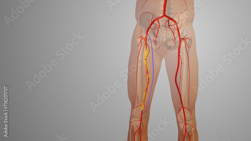 Peripheral artery bypass surgery medical animation photo