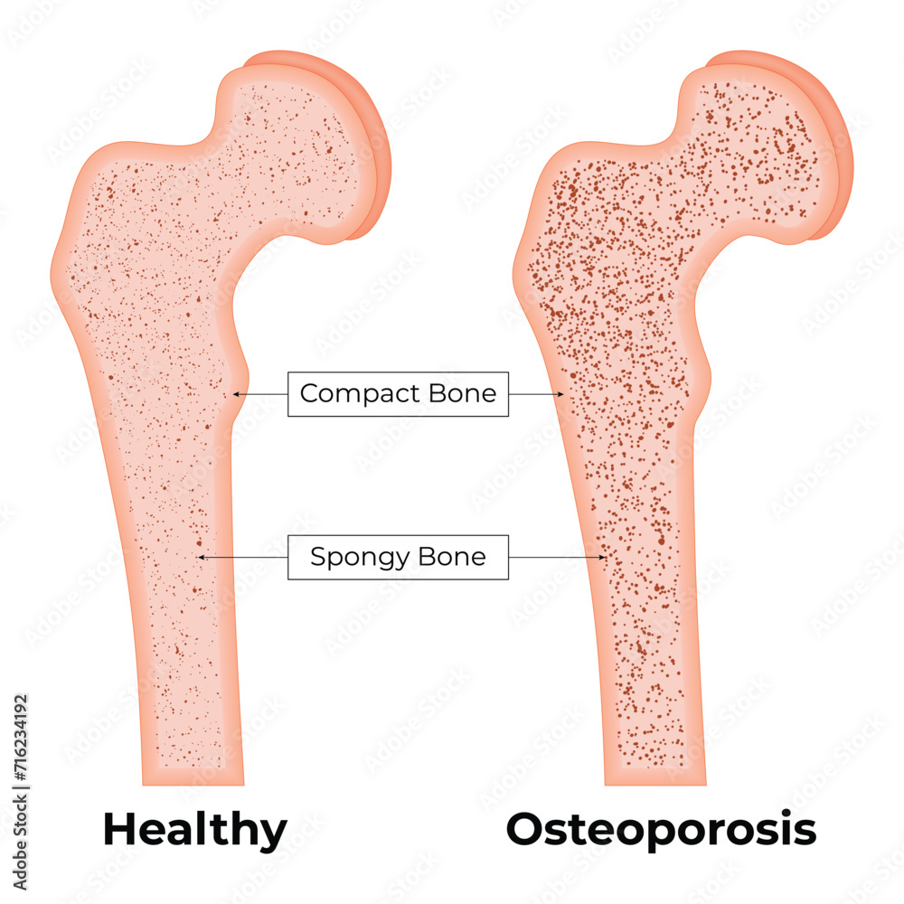 Healthy Osteoporosis Bone Science Design Vector Illustration Diagram Healthy Osteoporosis Bone Science Design Vector Illustration Diagram