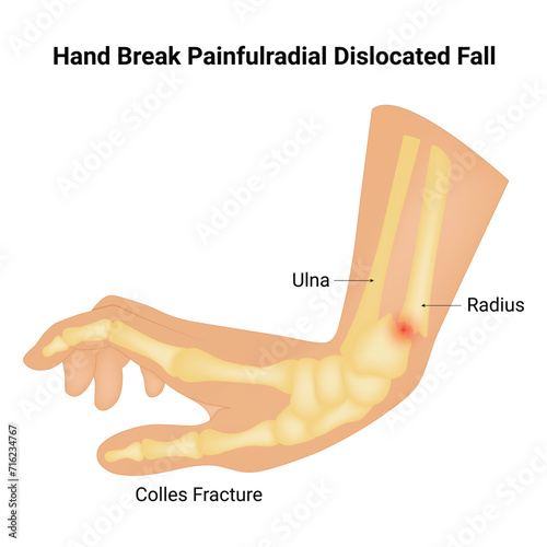 Hand Break Painfulradial Dislocated Fall Science Design Vector Illustration