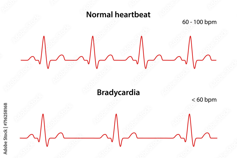 Diagram of normal rhythm and Bradycardia for a human heart. Heart cardiogram. Vector illustration in flat style isolated on white background