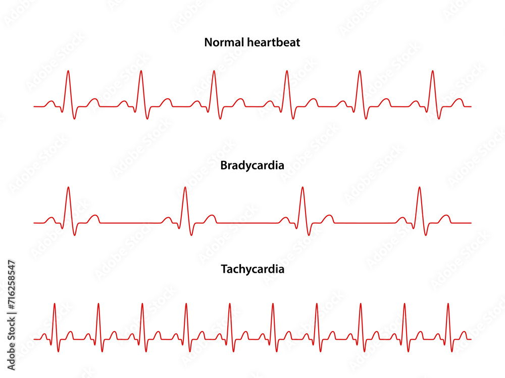 Diagram of normal rhythm, Tachycardia and Bradycardia for a human heart. Heart cardiogram. Vector illustration in flat style isolated on white background