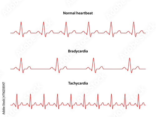 Diagram of normal rhythm, Tachycardia and Bradycardia for a human heart. Heart cardiogram. Vector illustration in flat style isolated on white background