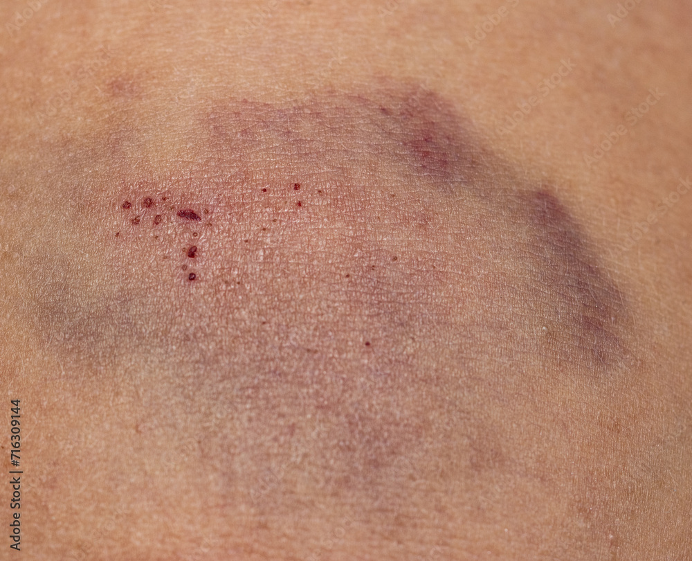 Fototapeta premium blue bruise on the skin of the arm.