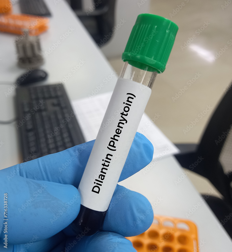Blood sample for Phenytoin test, therapeutic drug, to maintain a therapeutic level and diagnose potential for toxicity.