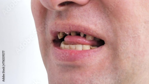 Periodontal disease, loose teeth in toothless man mouth, close up. Dental problems and orthodontic treatment for patient.