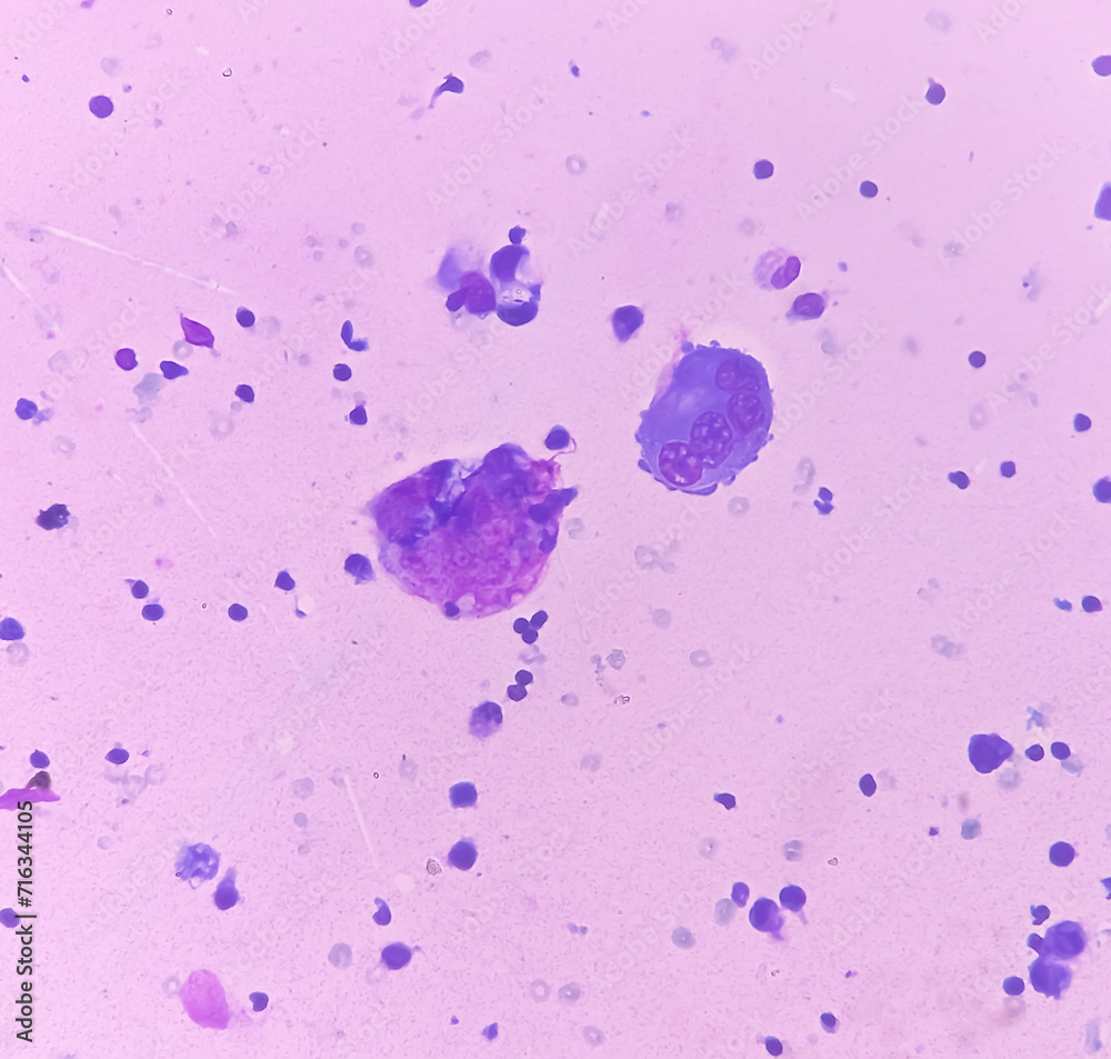 Ascitic fluid cytology. Leishman stain smear show Lymphocytes, polymorphs cells. Abnormal cells. Ascites.