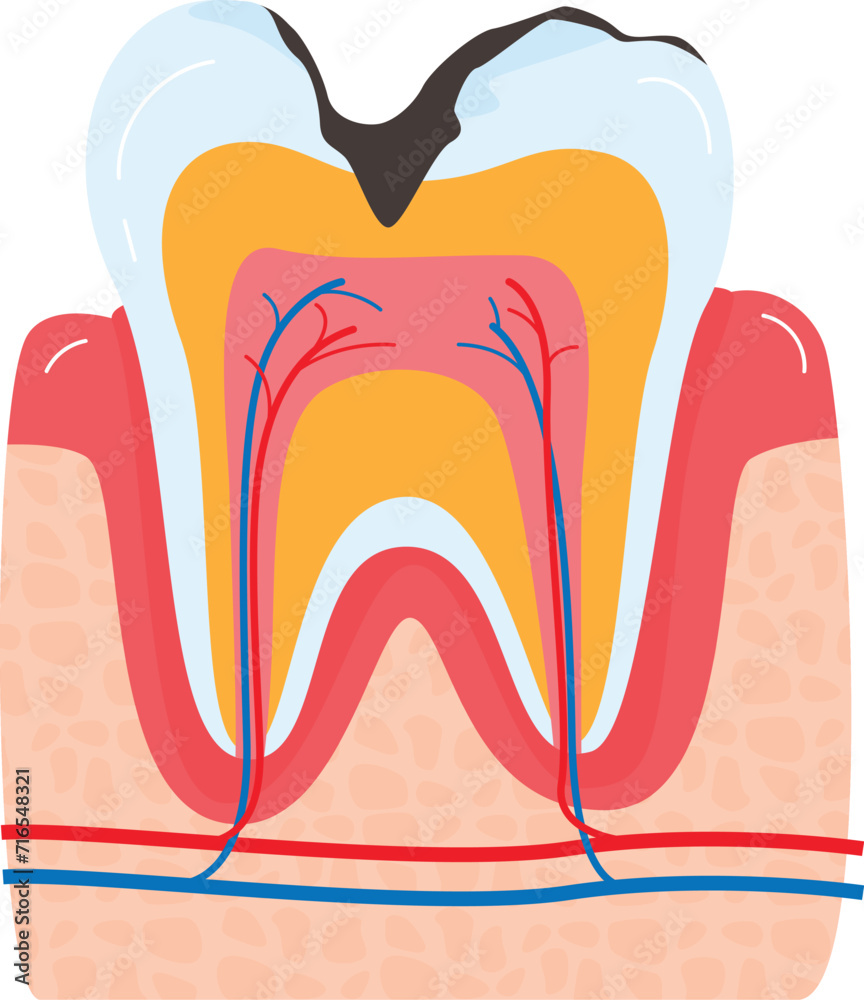 Cavity in molar tooth anatomy, cross section showing structure and layers. Dental health and caries concept vector illustration. Cavity in molar tooth anatomy, cross section showing structure and layers. Dental health and caries concept vector illustration.