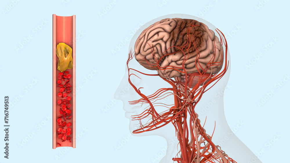 ISCHEMIC STROKE CARDIOVASCULAR DISEASE intelligence overview