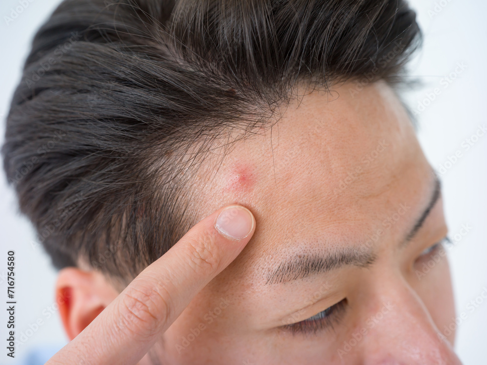 Obraz premium ニキビ