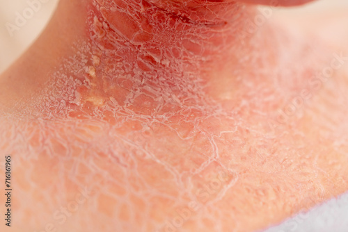 close-up of inflamed red crusted skin dermatology desquamation disease photo