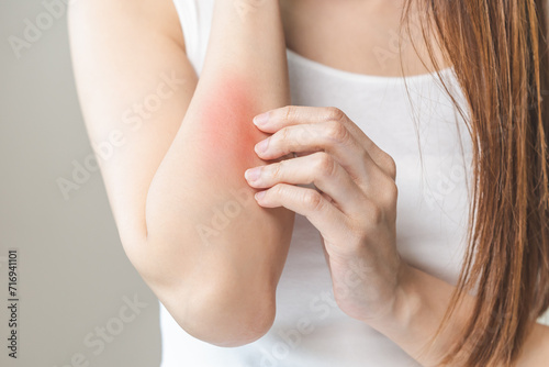 Wallpaper Mural Dermatology asian young woman, girl allergy, allergic reaction from atopic, insect bites on her arm, hand in scratching itchy, itch red spot or rash of skin. Healthcare, treatment of beauty. Torontodigital.ca