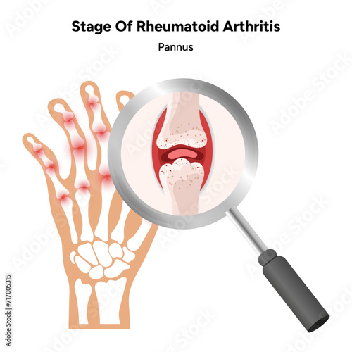 Medical infographic stage of rheumatoid arthritis joints pannus
