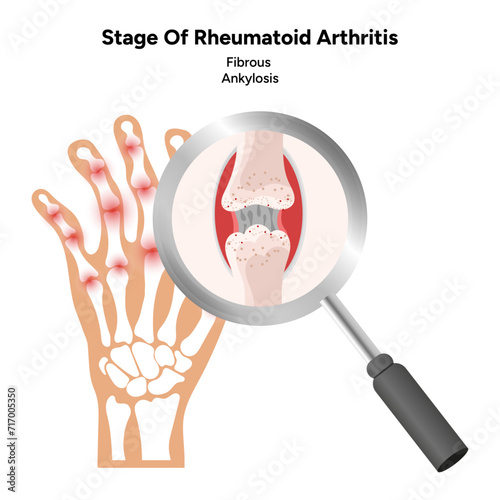 Medical infographic stage of rheumatoid arthritis joints fibrous ankylosis photo