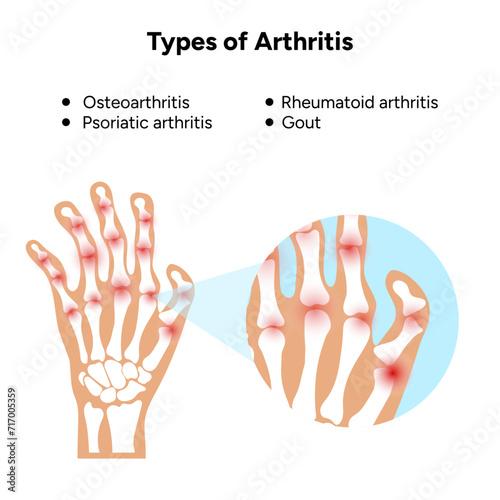 Medical illustration and information types of arthritis 