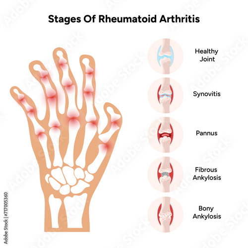 Medical infographic stage of rheumatoid arthritis joints 