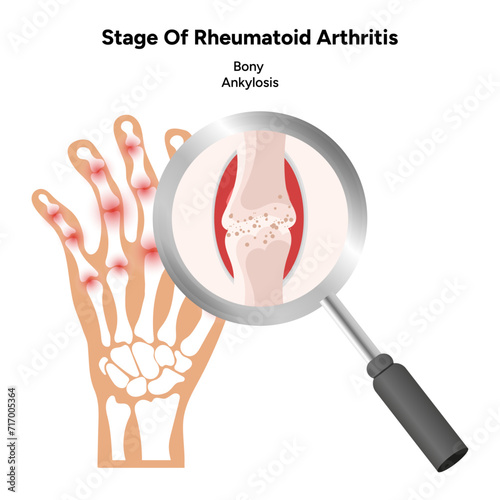 Medical infographic stage of rheumatoid arthritis joints bony ankylosis
