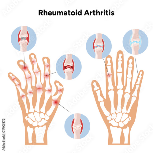 Medical infographic rheumatoid arthritis joints