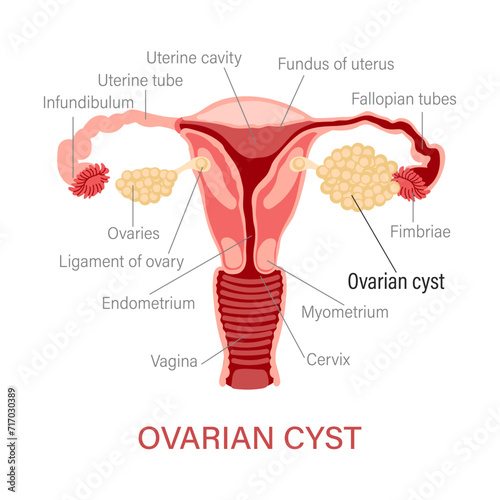 Ovarian cyst. Diseases of the female reproductive system. Gynecology. Medical concept. Infographic banner. Vector