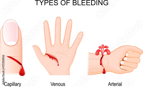 Types of bleeding. A Capillary, Venous and Arterial blood loss