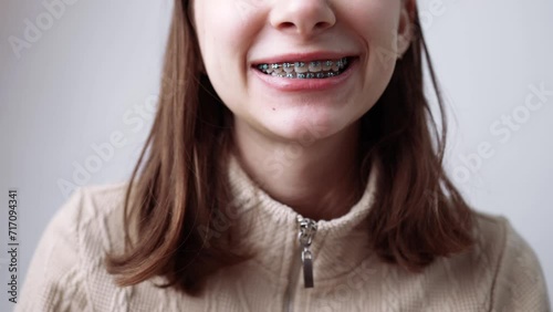 Young girl with abnormal teeth position and correction with metal braces. Open mouth close up. photo
