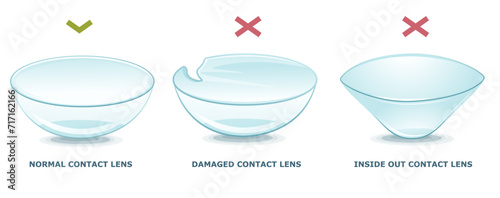 Normal contact lens, damaged contact lens, inside-out contact lens. How to check the lens. Infographic. Healthcare illustration. Vector illustration. 