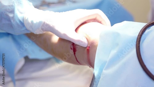 Hands of doctor and knee joint with cut and blood during surgery photo